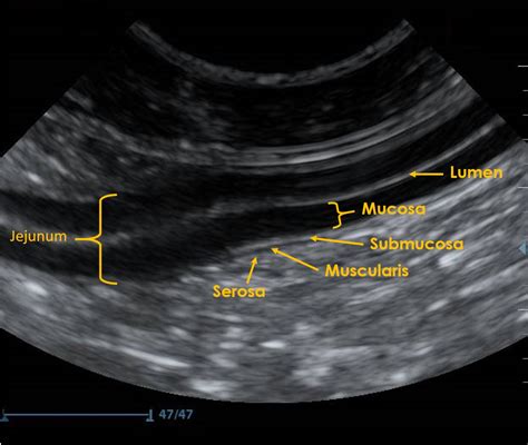 measurement of small intestine thickness|Ultrasonography of the gastrointestinal tract .